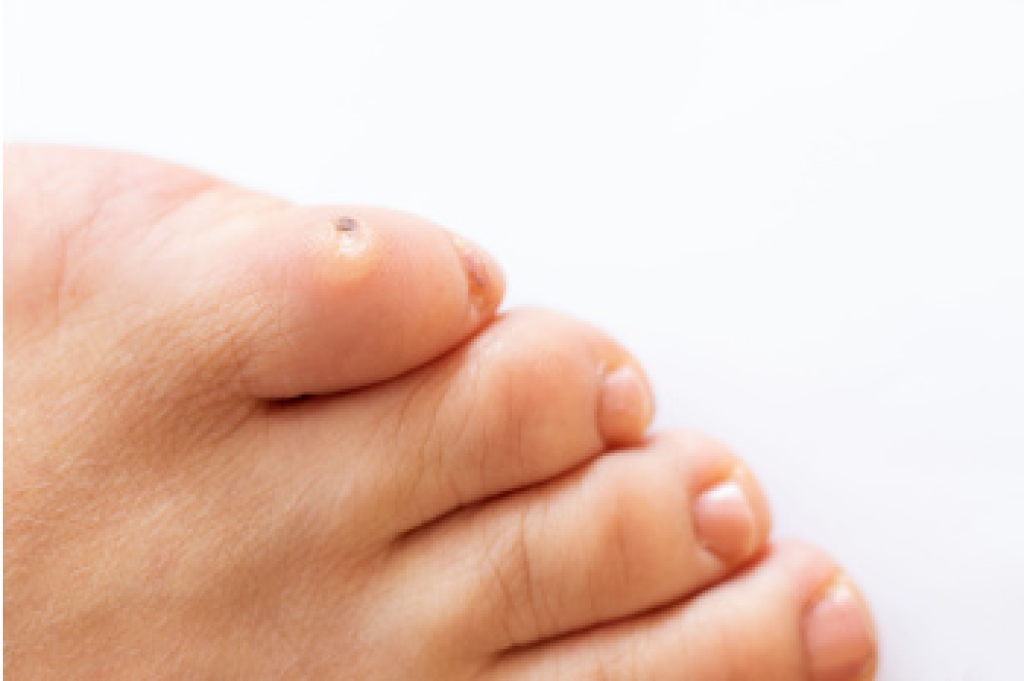 Treating Corns With Professional Foot Care