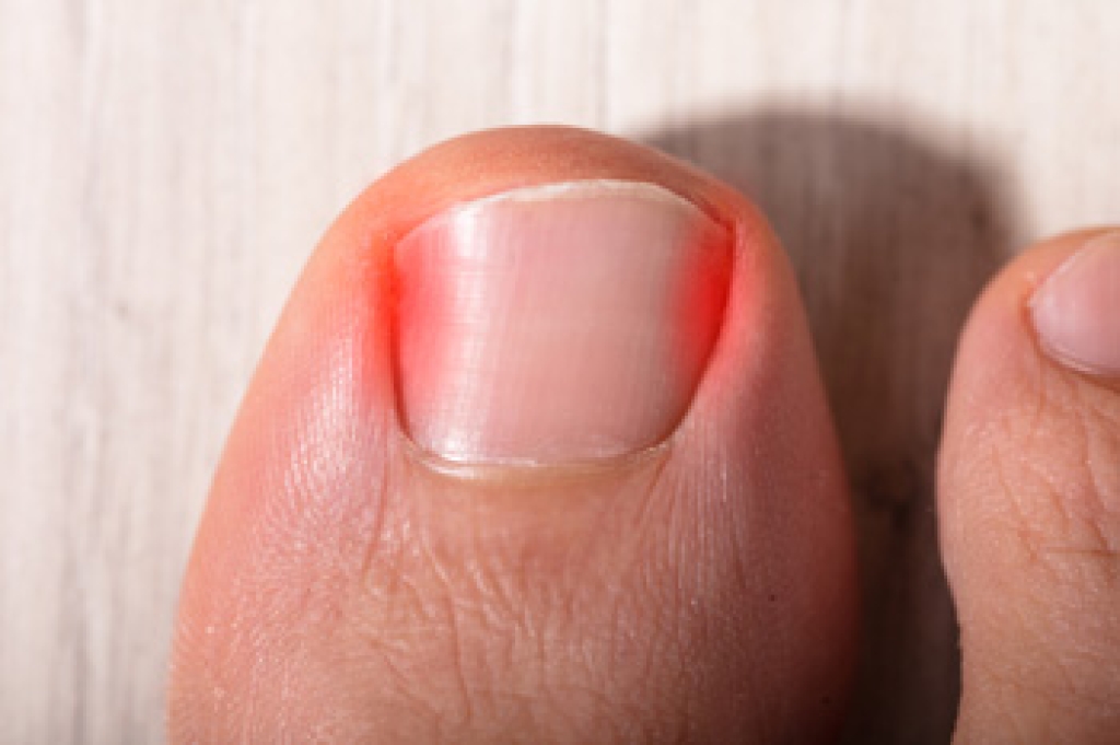 When an Ingrown Toenail Becomes Painful