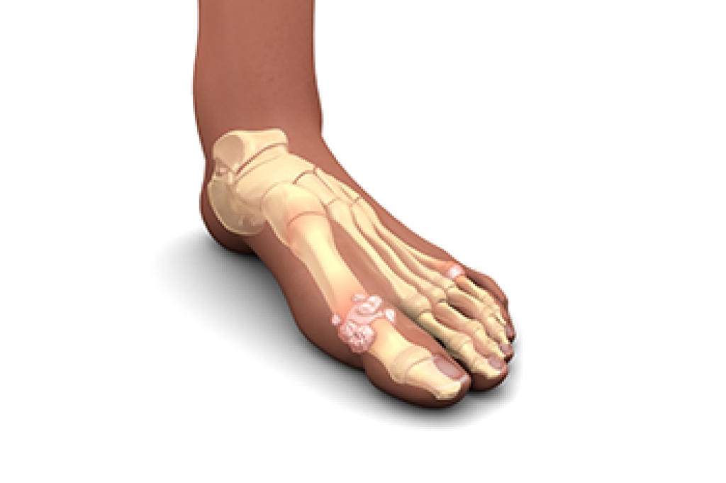 Facts About Gout
