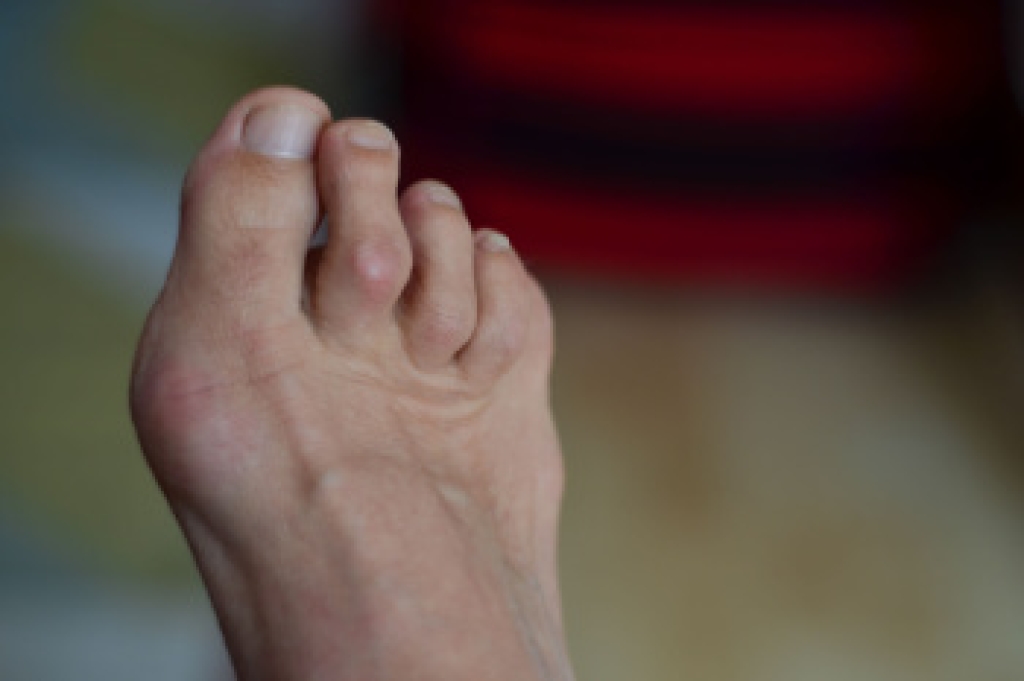 Hammertoe Explained