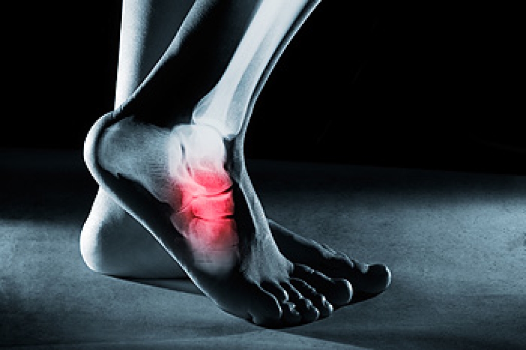 Recognizing Warning Signs of a Foot Stress Fracture